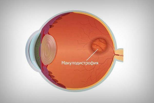Причины и симптомы макулодистрофии сетчатки глаза