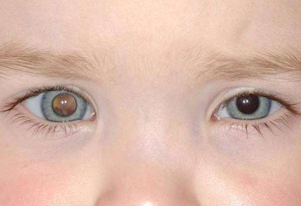 Рак сетчатки глаза: лечение детей и взрослых, симптомы, признаки