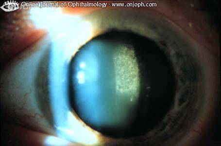 Дисцизия вторичной катаракты что делать