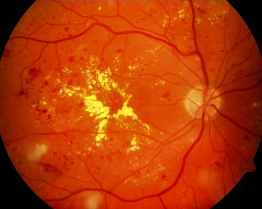 Диабетическая ретинопатия: симптомы, лечение, классификации