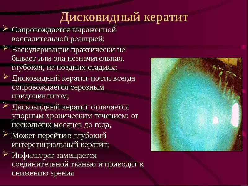 Герпетические поражения глаз (герпетический кератит) - симптомы болезни, профилактика и лечение герпетических поражений глаз (герпетического кератита), причины заболевания и его диагностика на eurolab
