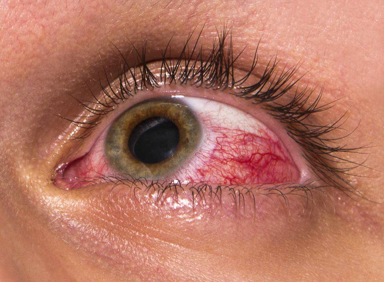 Грибковые заболевания глаз - фото, лечение, симптомы, причины