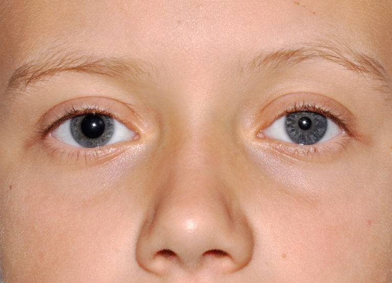 Разные по размеру зрачки у ребенка - причины анизокории