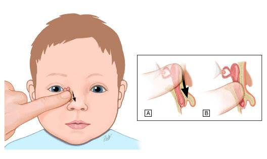 Дакриоцистит у новорожденных (детей): лечение, симптомы (фото), причины непроходимости слезного канала, массаж