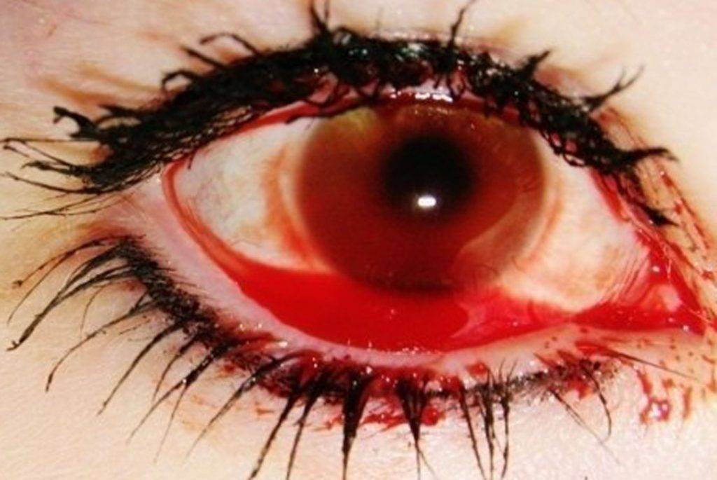 6 причин глазных кровоизлияний