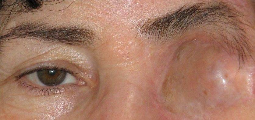 Энуклеация глаза (эвисцерация): операция по удалению глазного яблока
