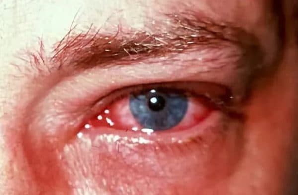 Ожог глаза: первая помощь и лечение роговицы каплями