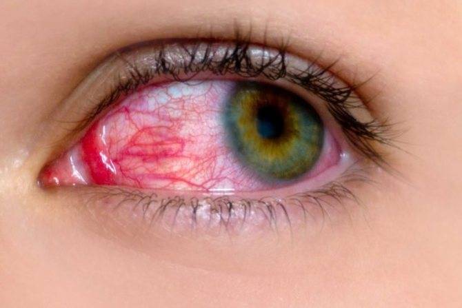 Красные глаза после сна: причины, симптоматика и методы лечения - "здоровое око"