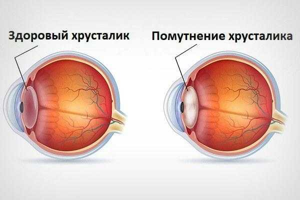 Эффективное лечение двоения в глазах — советы и рекомендации