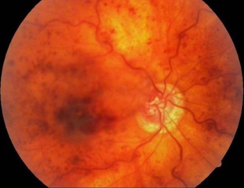 Ретинопатия глаз: диабетическая, фоновая, недоношенных, посттромбическая