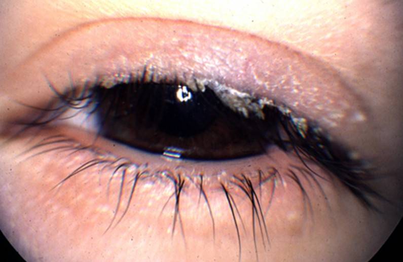 Демодекоз век: симптомы и лечение - "здоровое око"