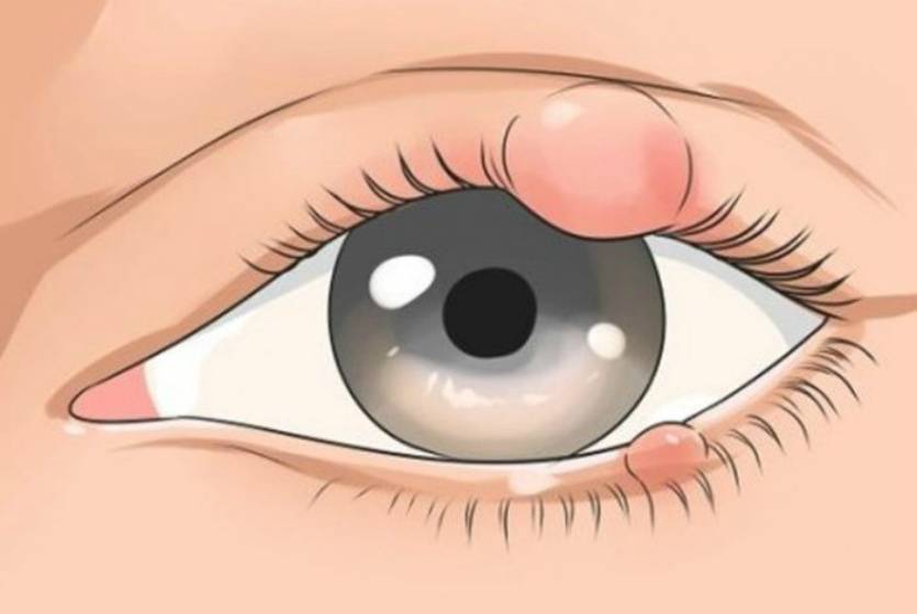 Внутренний ячмень на глазу: лечение, причины, симптомы (фото), как выглядит мейбомит, осложнения