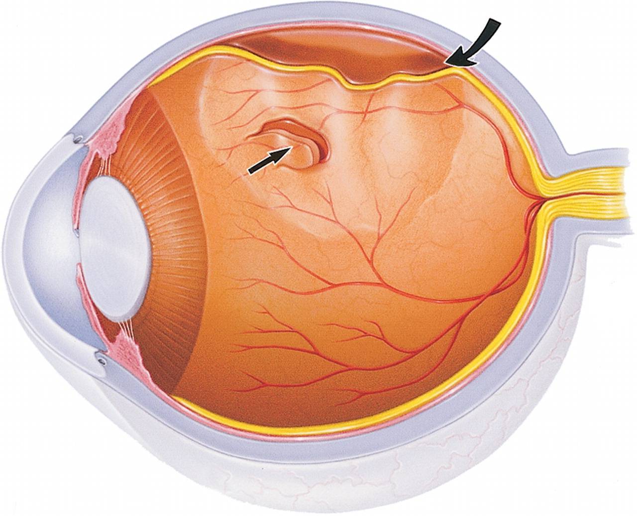 Разрыв сетчатки глаза: лечение, причины, последствия