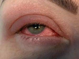 Причины того, что гноятся глаза у взрослого, чем лечить?