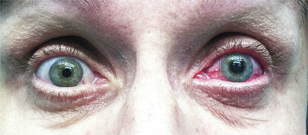 Список заболеваний глаз у человека — описание симптомов