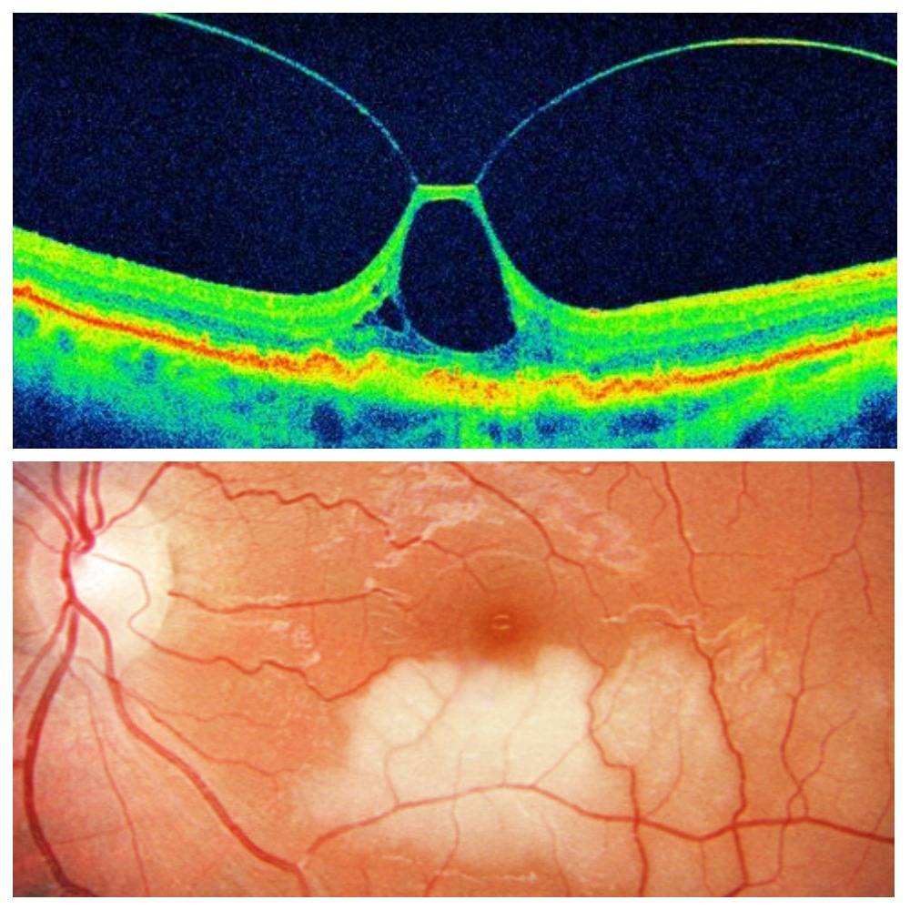 Сетчатка глаза причины. Макулярный отек сетчатки. Макула отслойка сетчатки. Макулярный разрыв сетчатки. Травматический макулярный разрыв сетчатки.
