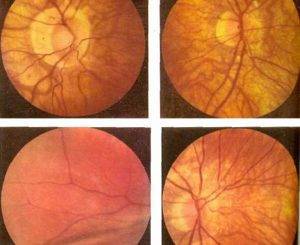 Стафилома диска зрительного нерва. миопический конус и стафилома — причины и лечение. важные клинические признаки
