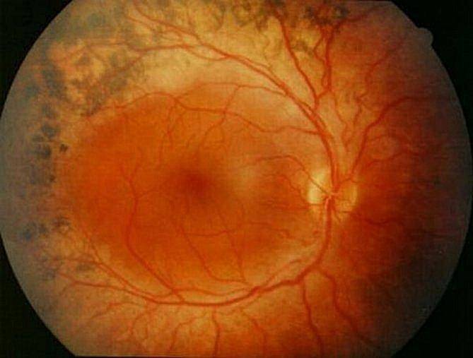 Отслоение сетчатки глаза: операция для восстановления зрения