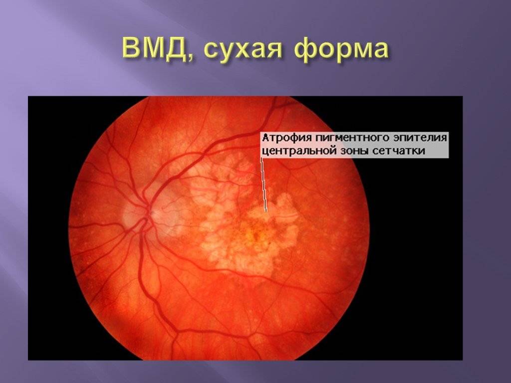 Дистрофия сетчатки глаза - что это такое... симптомы, лечение и последствия - sammedic.ru