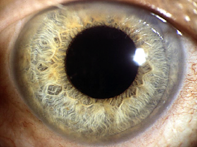 Заболевания глаз. часть 2. заболевания роговицы, хрусталика, стекловидного тела, радужной оболочки и сетчатки