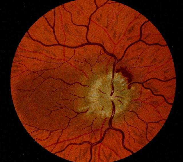 Неврит зрительного нерва - причины, симптомы и лечение