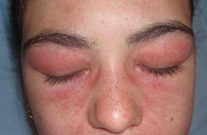 Белки глаз красные: причины, лечение у взрослых и детей, сопутствующие симптомы (красные прожилки, боль), последствия