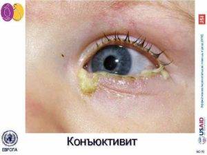 Выделения из глаз у ребенка при простуде: причины, почему гноятся глаза при орви и после сна
