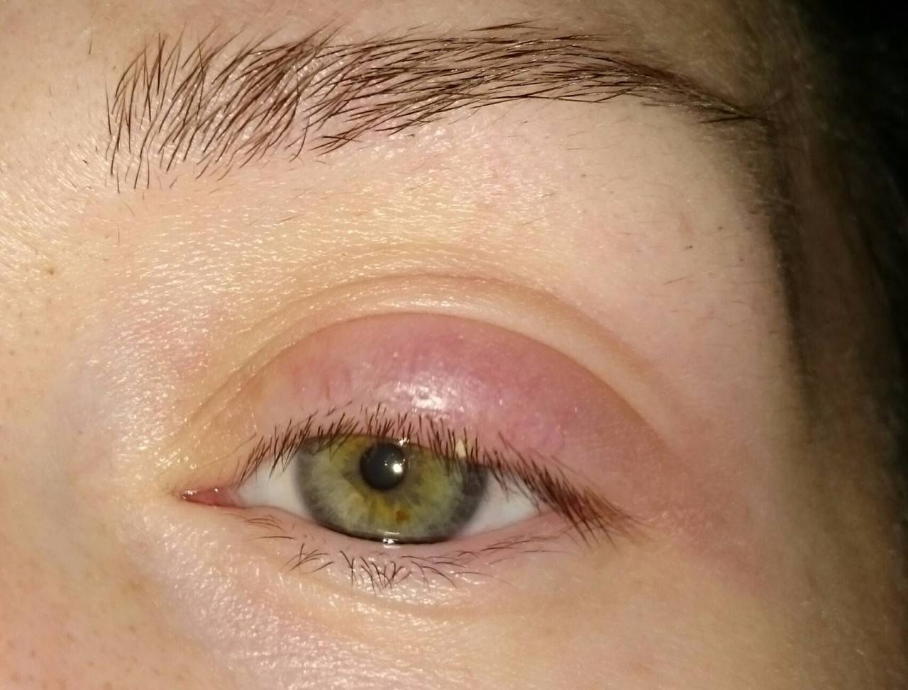 Чем опасен аллергический отек глаз и как его снять?