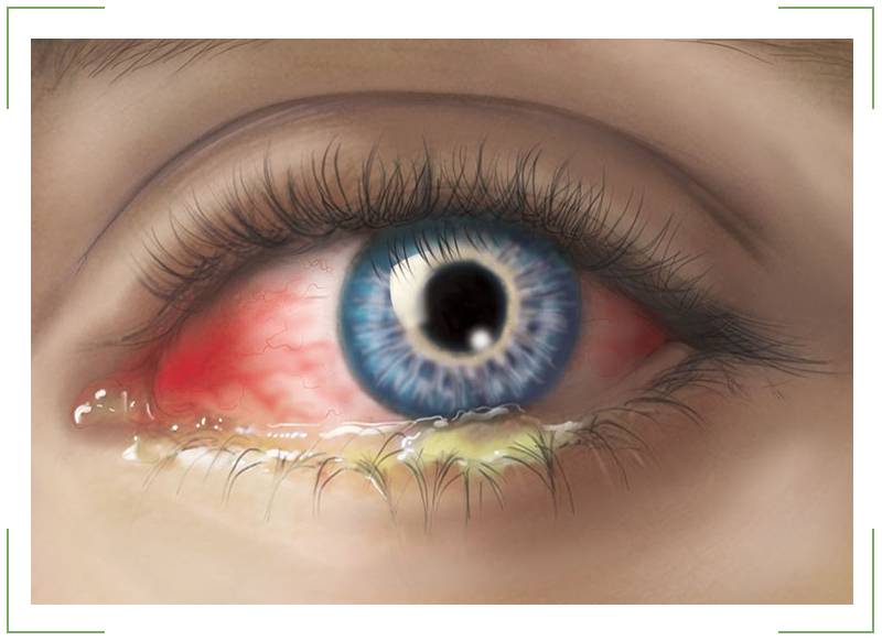 Острый конъюнктивит: симптомы и лечение - "здоровое око"