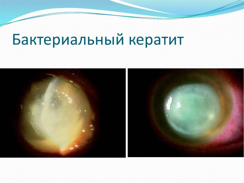 Кератит глаз у взрослых: признаки, симптомы, лечение. как лечить кератит глаз