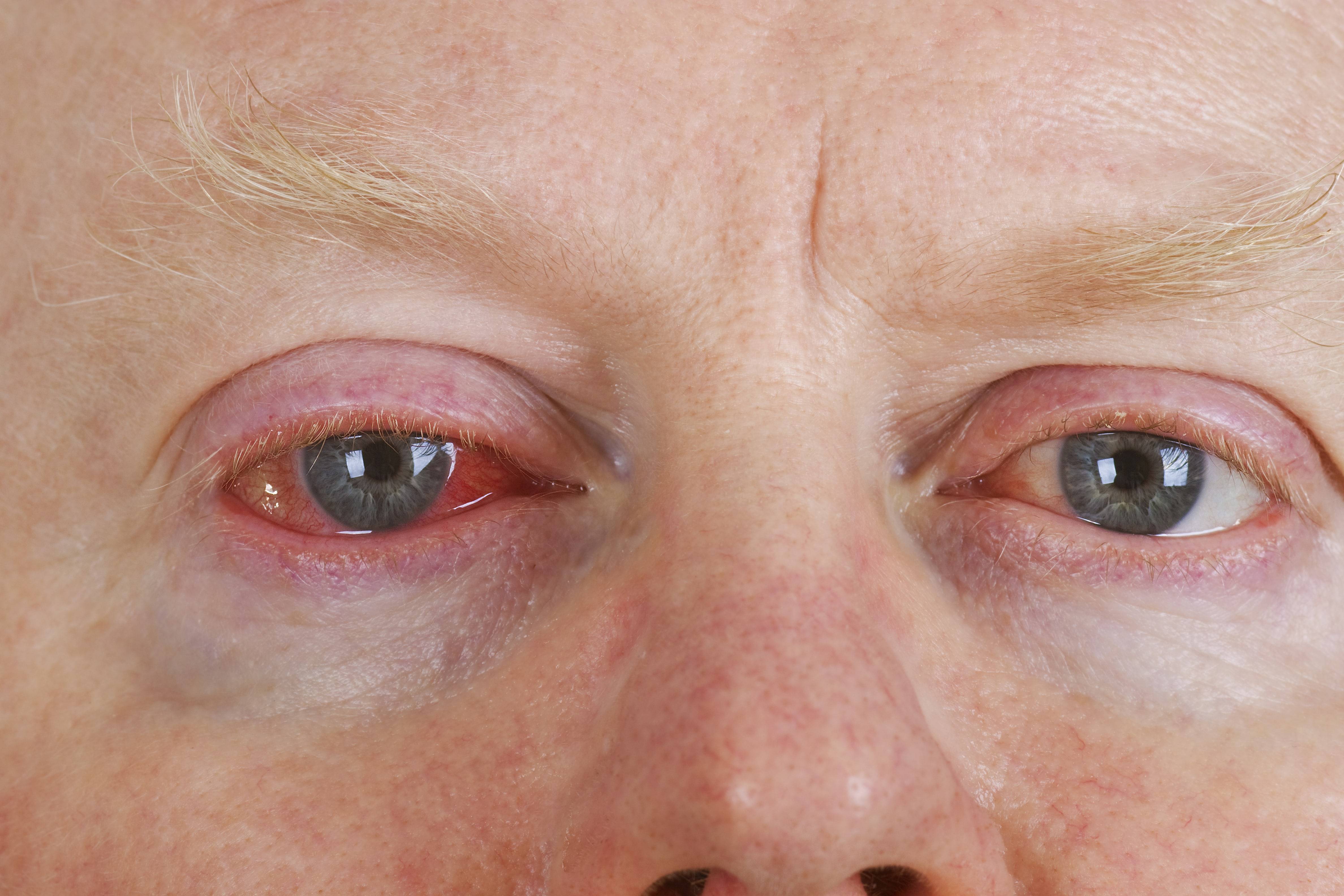 Герпес глаза: симптомы, диагноз и лечение