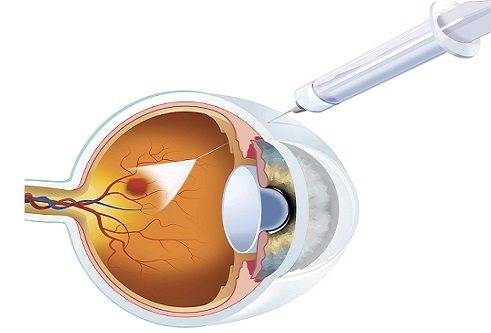Влажная форма макулодистрофии сетчатки глаза: лечение