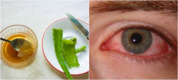 Халязион век у ребенка: лечение холязионов на глазу, как правильно лечить по доктору комаровскому