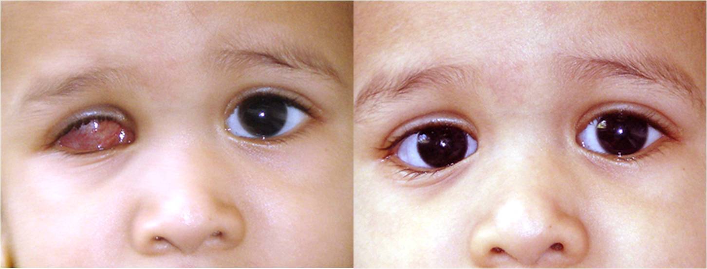Рак глаза: первые симптомы у детей и взрослых