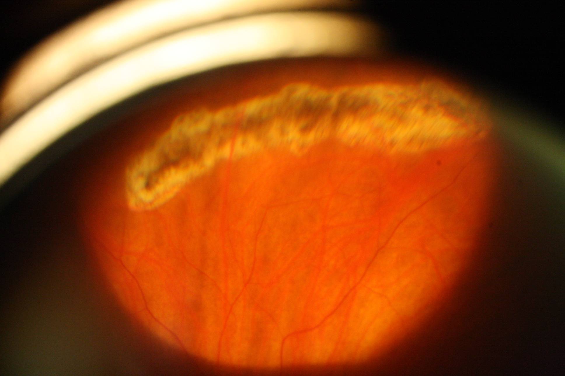 Дистрофия сетчатки глаза - что это такое... симптомы, лечение и последствия