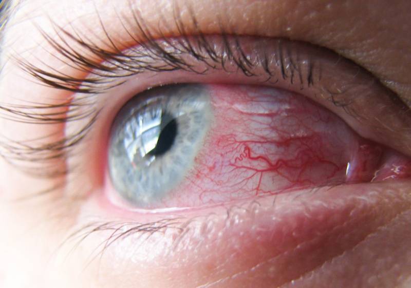Грибковая инфекция глаз: виды поражений и препараты от грибка