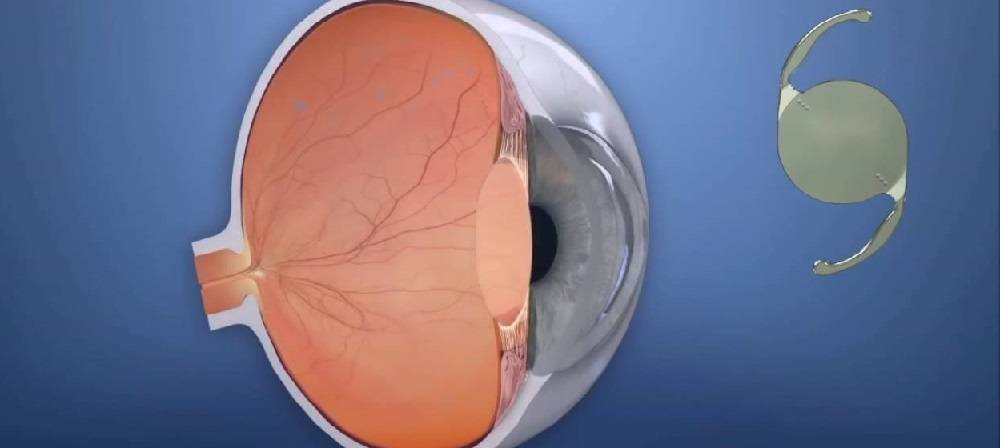 Хрусталик глаза: какой лучше импортный или отечественный, искусственный при катаракте, виды и срок службы, как заменить повторно