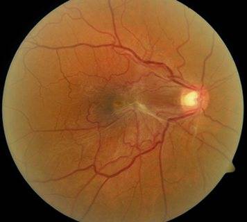 Что такое эпиретинальный фиброз глаз. народные рецепты для лечение фиброза сетчатки глаза - новая медицина