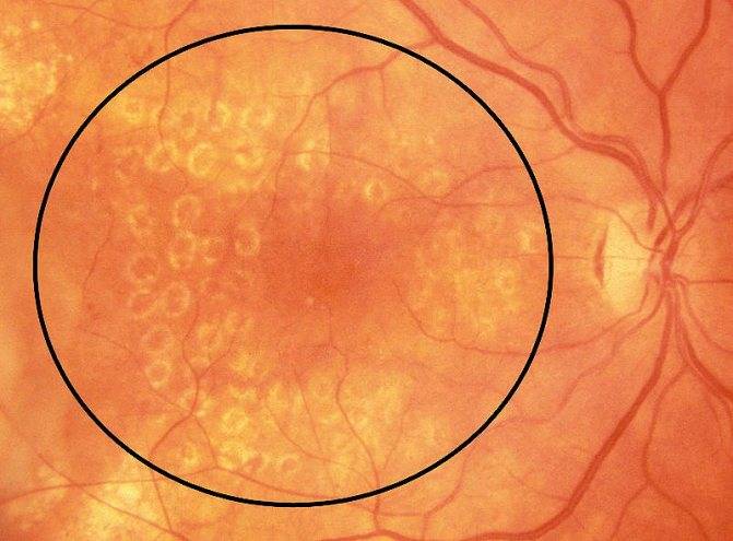 Возрастная макулярная дегенерация — прогрессирующее глазное заболевание