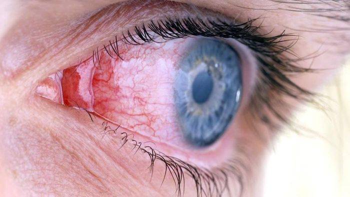Как убрать красноту глаз в домашних условиях - "здоровое око"