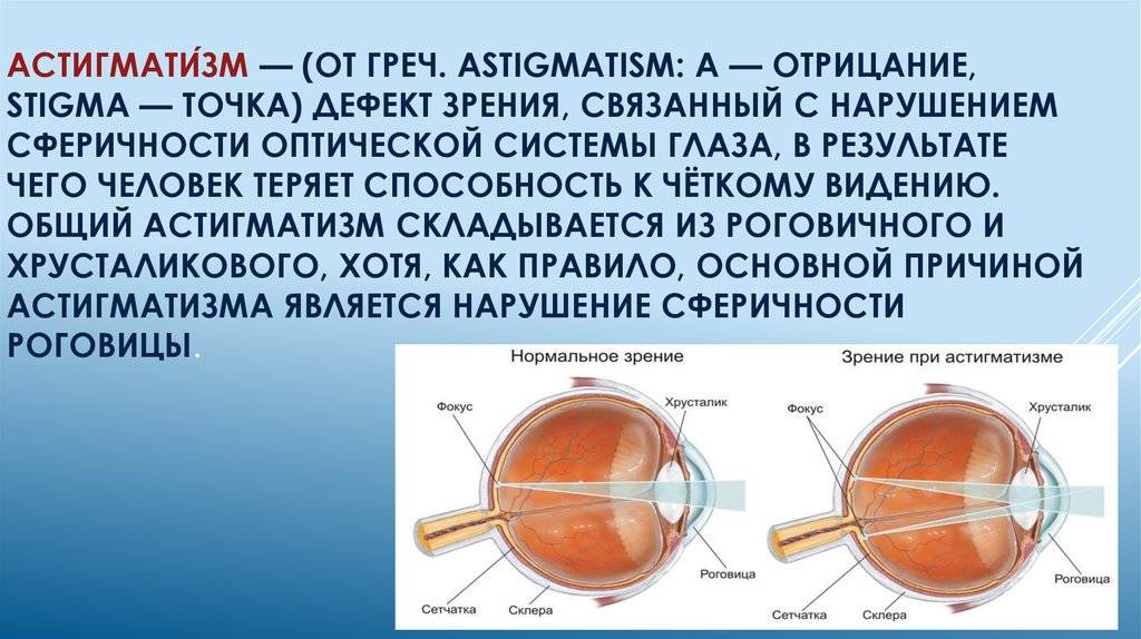 Астигматизм глаз – что это такое? симптомы, диагностика и лечение