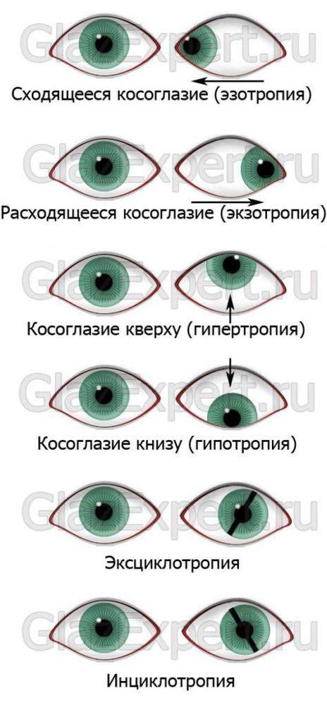 Косоглазие у детей: причины появления и способы его диагностики — глаза эксперт