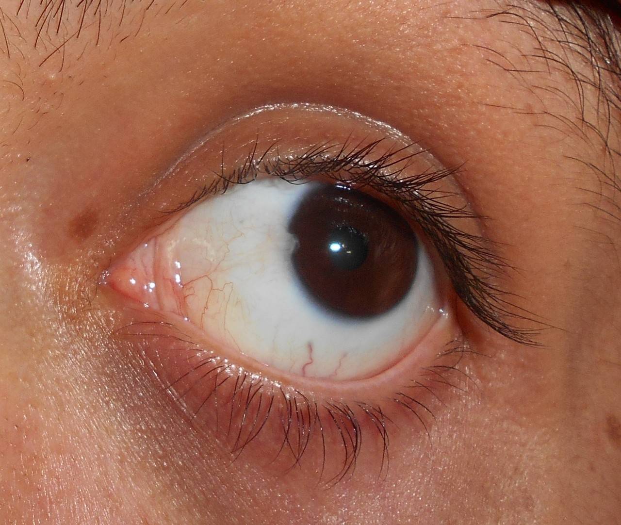 Откуда появляется желтое пятно на белке глаза. желтые пятна на глазном яблоке - лечение