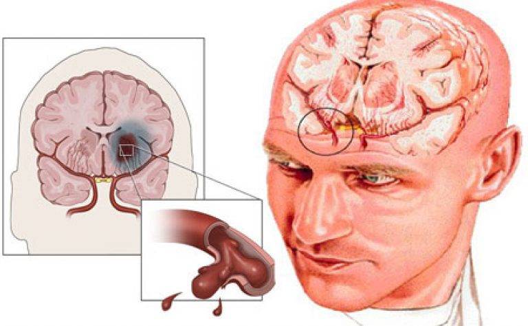 Инсульт глаза — первые проявления и виды патологии, медикаментозная терапия и профилактические меры