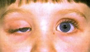 Синдром горнера (синдром бернара-горнера, окулосимпатический синдром)