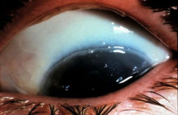 Химические ожоги глаз