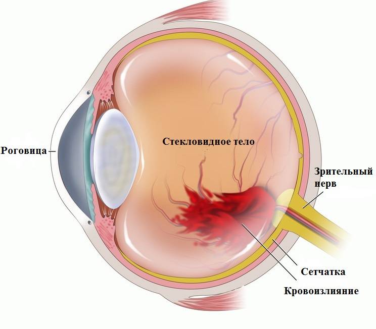 Кровоизлияние в глаз: причины и лечение, что делать при кровотечении