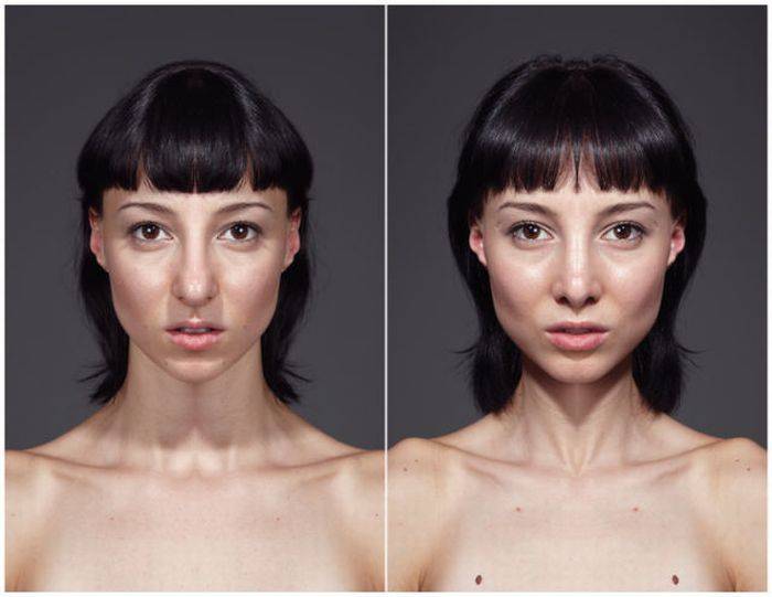 Асимметрию лица можно исправить без пластической операции