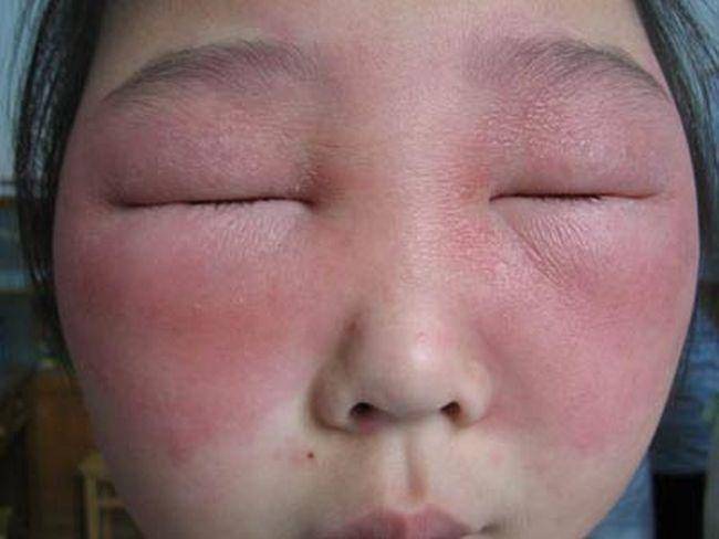 Отек глаз при аллергии - как быстро снять опухлость