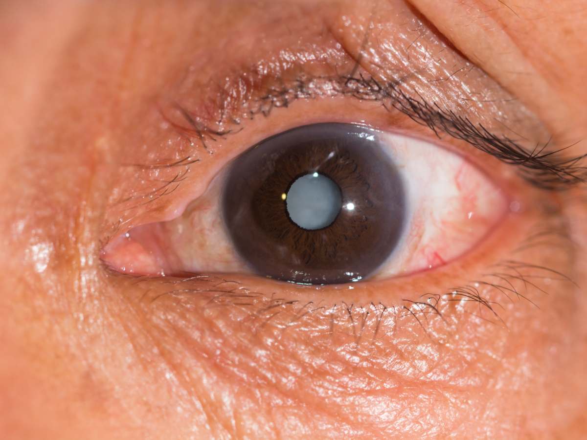 Мерцание в глазу после удаления катаракты
